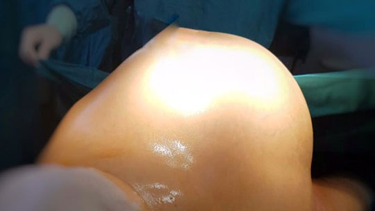 В Одинцово женщине удалили опухоль весом 12 кг 