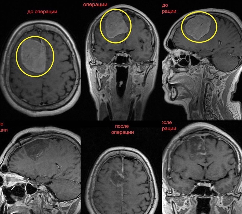 Врачи Одинцовской ОБ провели уникальную операцию по удалению опухоли головного мозга
